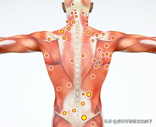 筋膜炎最新研究及治疗进展综述